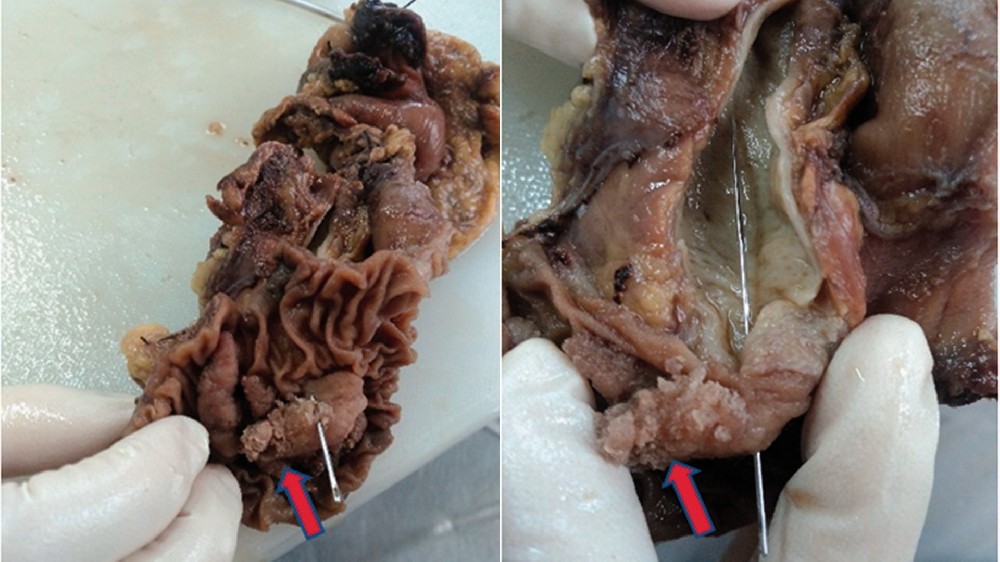 睪丸癌 1 睪丸癌