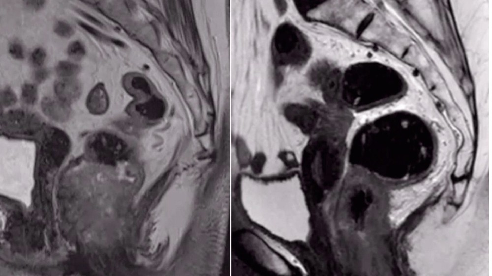 肛門癌(肛門癌) 1 肛門癌(肛門癌)