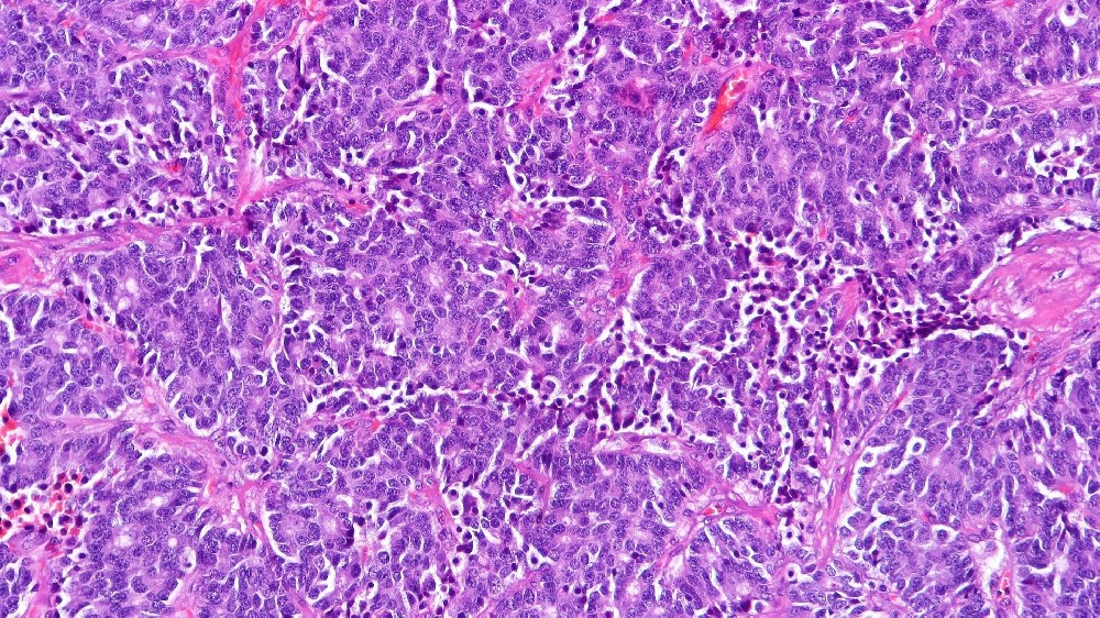 類癌（神經內分泌腫瘤）