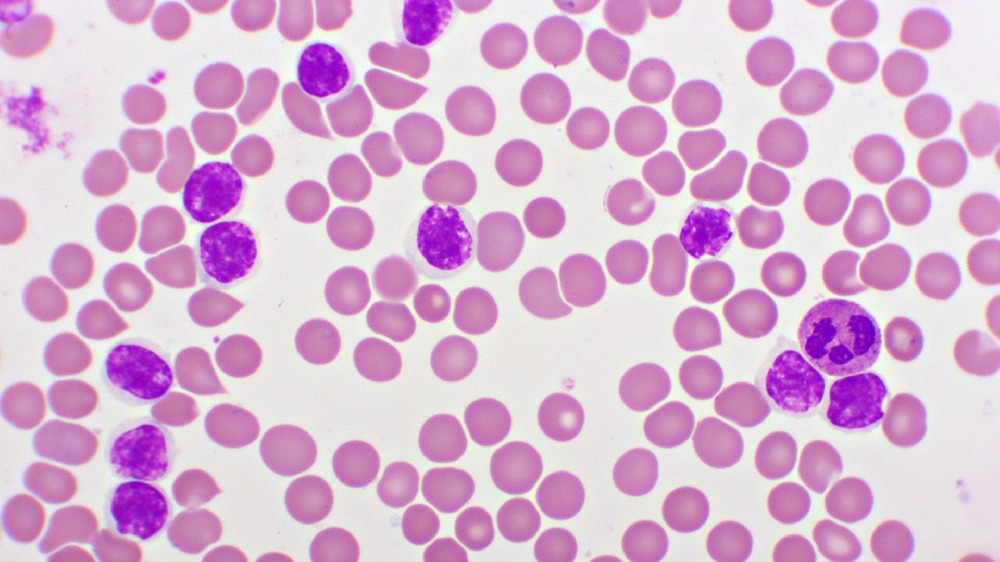 慢性淋巴細胞白血病 (CLL)