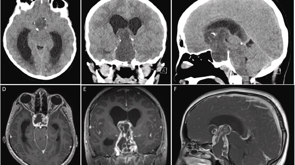 顱咽管瘤(良性腦腫瘤)1 顱咽瘤(良性腦腫瘤)