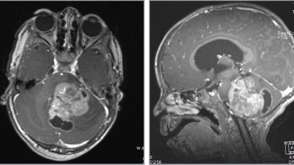 彌漫性內在性腦脊髓膠質瘤 (DIPG)