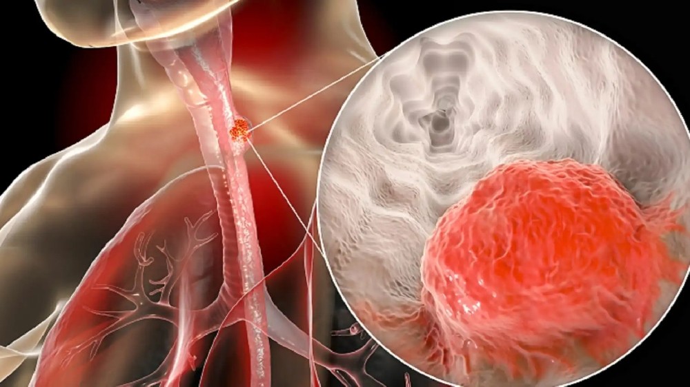 食道癌（食道癌）