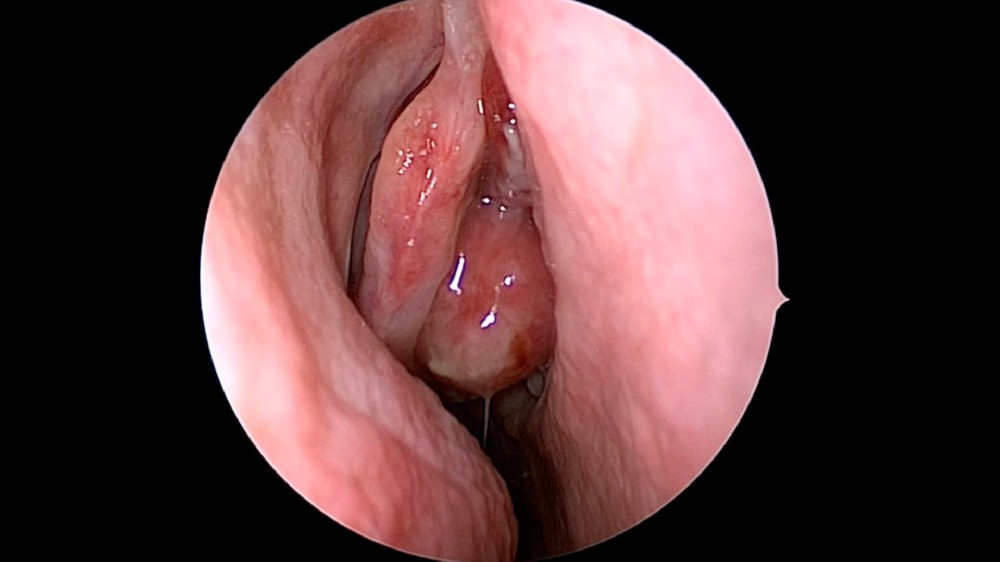 脂肪細胞瘤(嗅覺神經母細胞瘤)1 嗅覺神經母細胞瘤 (Esthesioneuroblastoma)