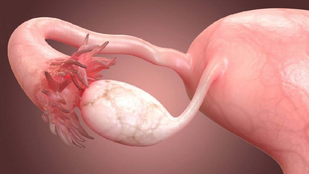 輸卵管癌 (Fallopian Tube Carcinoma)