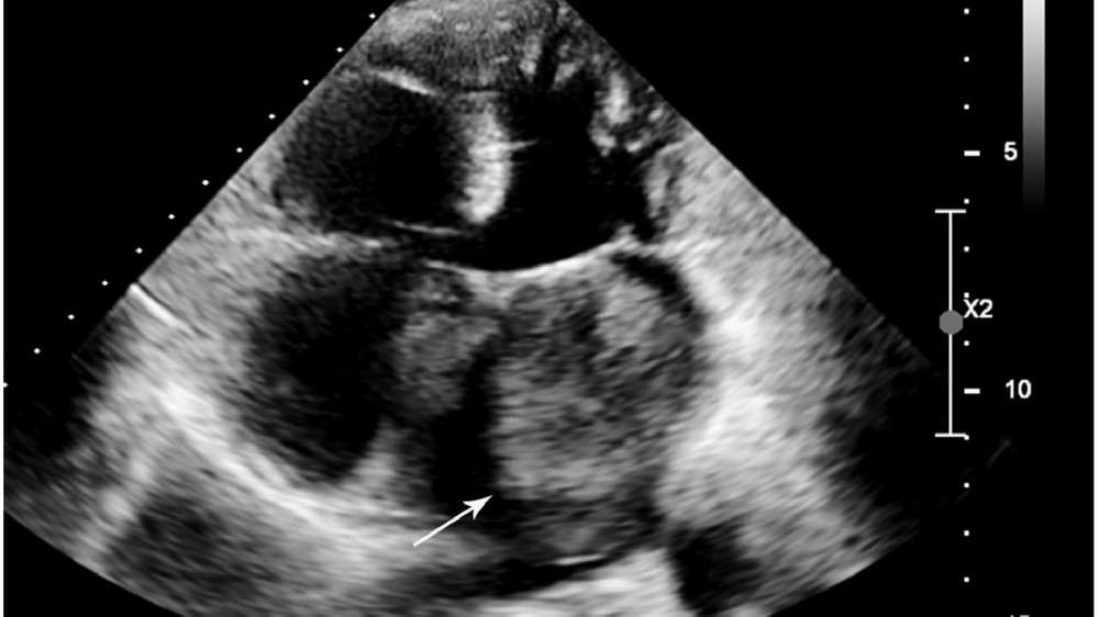 心臟癌(心臟肉瘤) 1 心臟癌(心臟肉瘤)