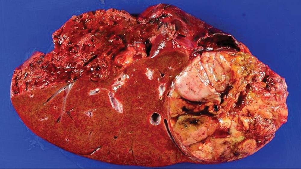 肝細胞癌(肝癌) 1 肝細胞癌(肝癌)