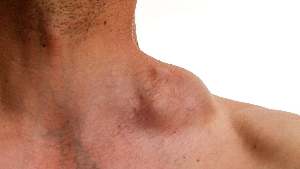 霍奇金淋巴瘤（霍奇金病）