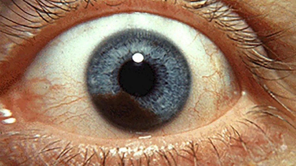 眼內黑色素瘤(葡萄膜黑色素瘤)1 眼內黑色素瘤(葡萄膜黑色素瘤)