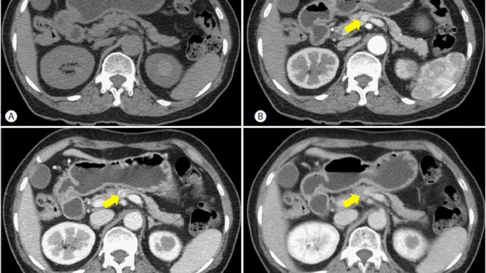 胰腺神經內分泌腫瘤