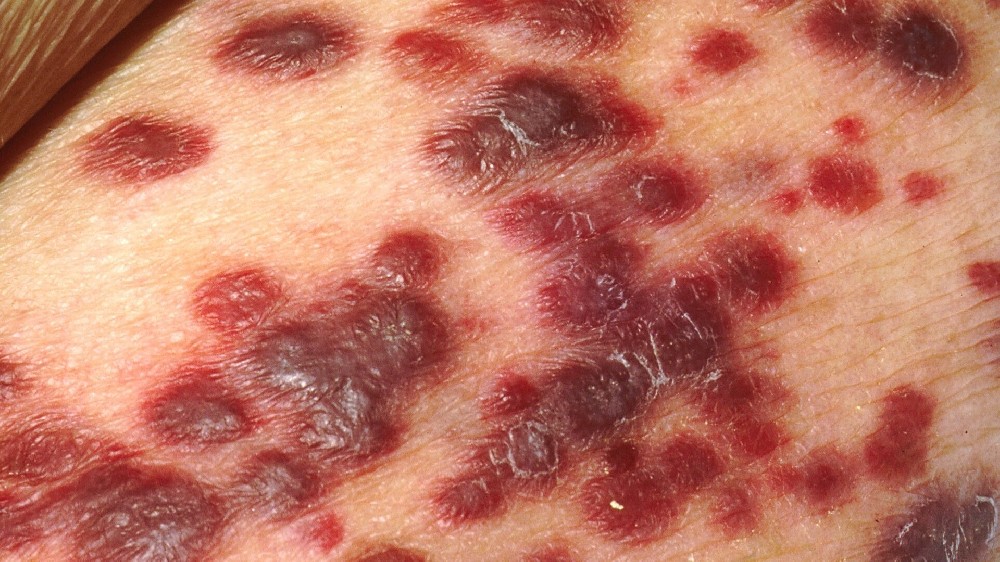 卡波西肉瘤 (KS) 1 卡波西肉瘤 (KS)