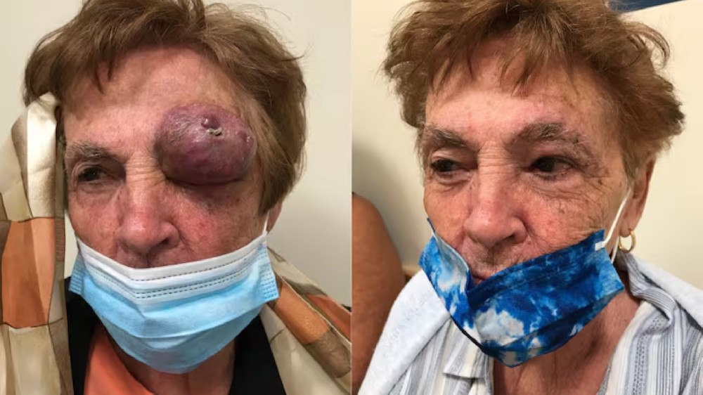 梅爾克細胞癌（梅爾克細胞皮膚癌）