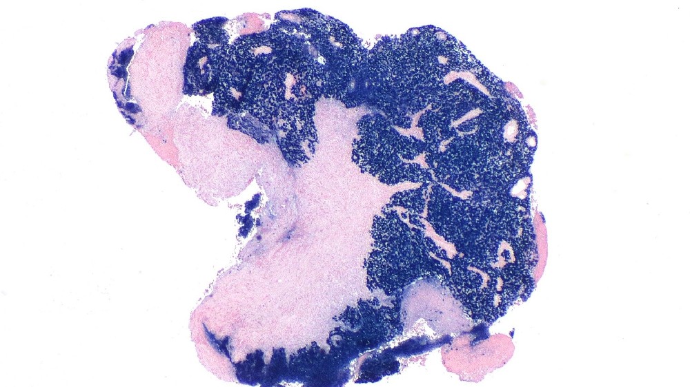 鼻咽癌 (Nasopharyngeal Carcinoma) 1 鼻咽癌 鼻咽癌