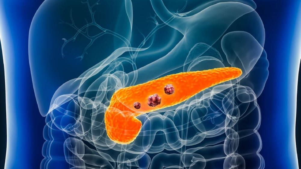 胰臟癌