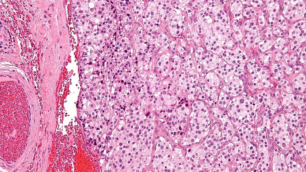 Paraganglioma