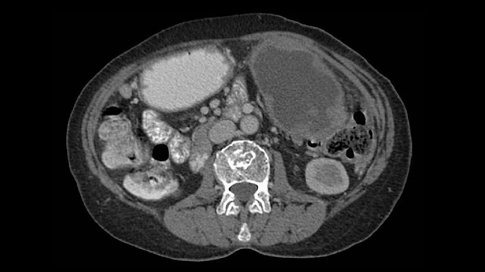 原發性腹膜癌（原發性腹膜癌）
