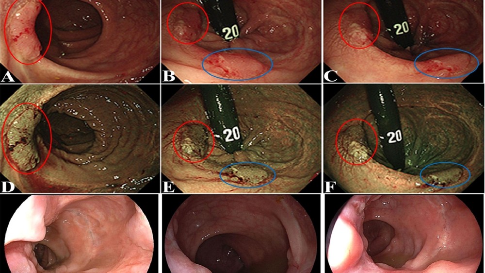 直腸癌 (Rectal Carcinoma)