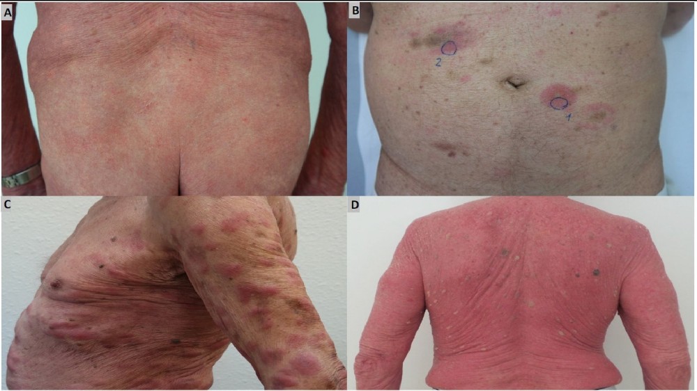 Sézary 綜合症(白血病性皮膚 T 細胞淋巴瘤)1 Sézary 綜合症(白血病性皮膚 T 細胞淋巴瘤)