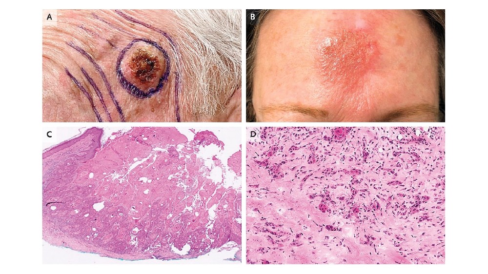 皮膚癌(皮膚癌) 1 皮膚癌(皮膚癌)
