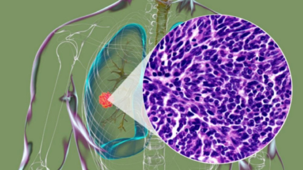 小細胞肺癌 (SCLC) 1 小細胞肺癌 (SCLC)