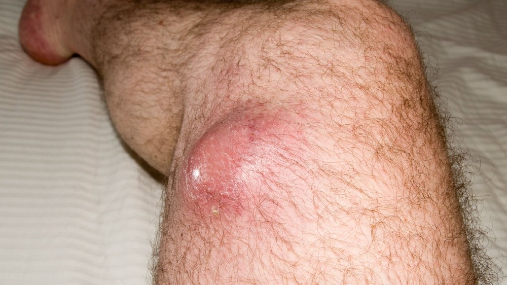 軟組織肉瘤 (STS) 1 軟組織肉瘤 (STS)