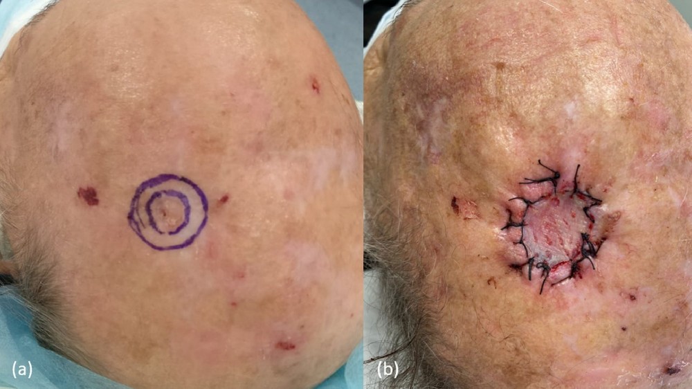 鱗狀細胞皮膚癌 (Squamous Cell Carcinoma) 1 鱗狀細胞皮膚癌 Squamous Cell Carcinoma