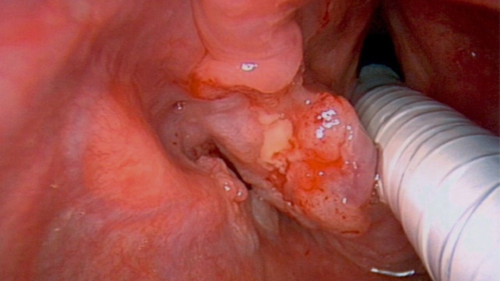 喉癌(咽癌) 1 喉癌(咽癌)