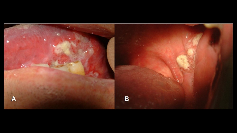 扁桃體癌(扁桃體癌) 1 扁桃腺癌 扁桃腺腫瘤