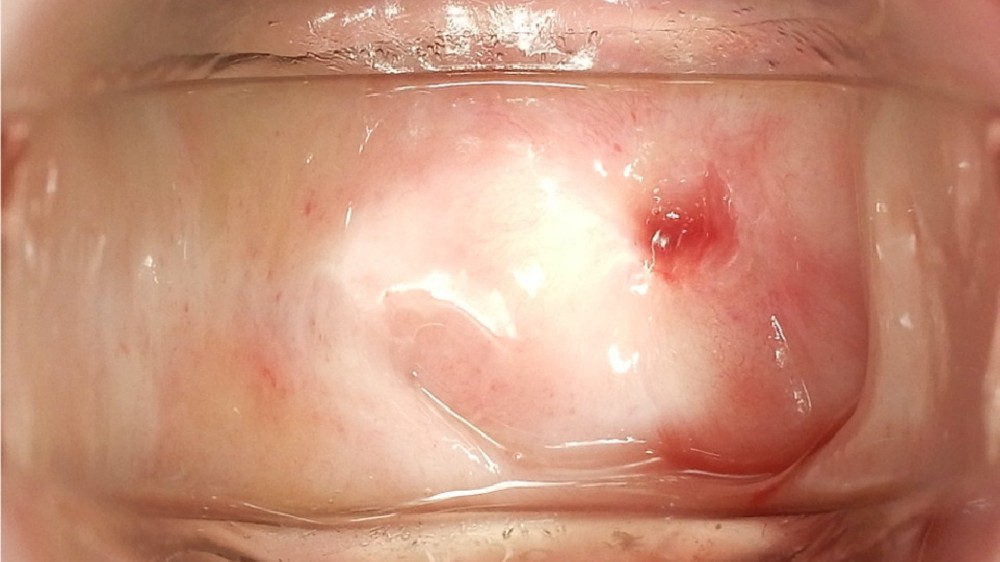 尿道癌 (Urethral Carcinoma) 1 尿道癌 (Urethral Carcinoma)