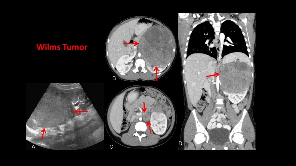 Wilms 腫瘤(腎母細胞瘤)1 Wilms 腫瘤(腎母細胞瘤)