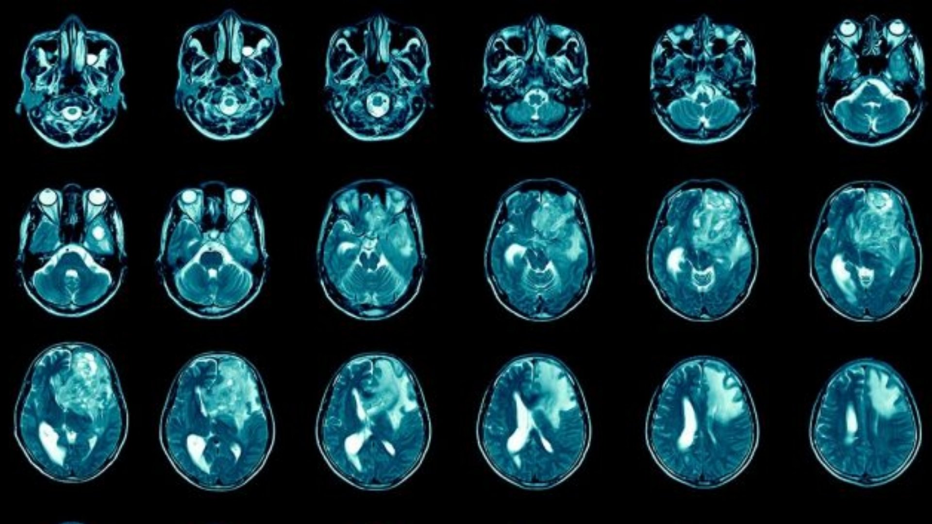 膠質母細胞瘤 (GBM)