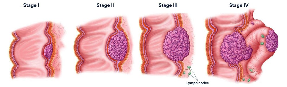 血液檢驗是否可辨識癌症